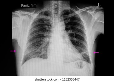 A Chest Xray Film Of A Patient With Right Lower Lung Pneumonia And Left Lower Lung Plate Atelectasi.