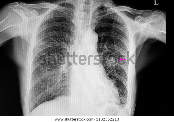 Chest Xray Film Patient Right Middle Stock Photo (Edit Now) 1132352213