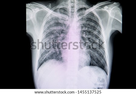 A chest xray film of a patient with severe  atypical pneumonia most likely pneumocystis carinii pneumonia or SARS-CoV-2 virus covid-19 infection.
