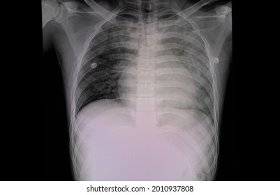 Chest X-ray Film Of A Patient With Shortness Of Breath Showing Cardiomegaly And Bilateral Pulmonary Edema