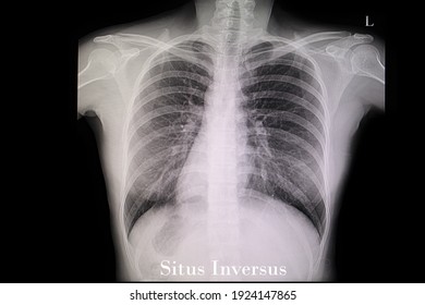 A Chest Xray Film Of A Patient With Sitis Inversus, A Conditon In Which The Organs In The Chest And Abdomen Are Positioned In A Mirror Image From Their Normal Positions.