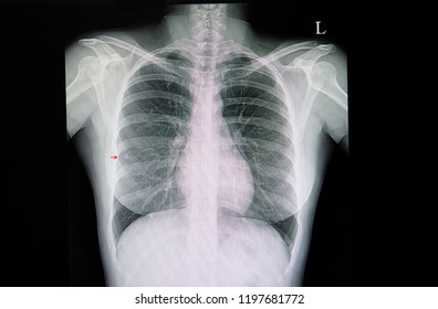 A Chest Xray Film Of A Patient With A Small Right Middle Lung Nodule. Possible Benign Or Malignant Tumor Or Cancer Of The Lungs. 