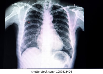 A Chest Xray Film Of A Patient With A Small Nodule  In His Right Upper Lung.  A Case Of Abnormal X Ray. Pulmonary Tumor Suspected. 