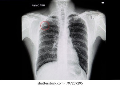 A Chest Xray Film Of A Patient With A Small Right Upper Lung Nodule