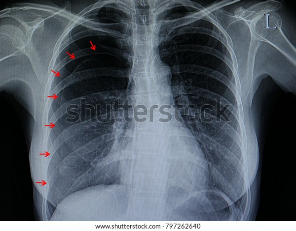 Chest Xray Film Patient Spontaneous Pneumothorax Stock Photo (Edit Now ...