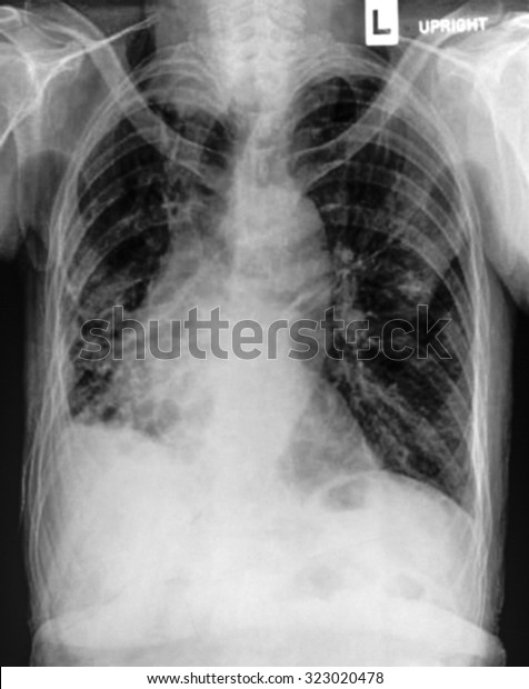 Chest Xray Film Showing Perihilar Infiltration Stock Photo 323020478 ...