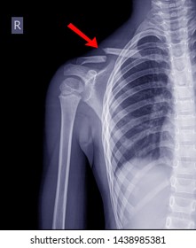 Chest Xray Fracture Right Clavicle On Stock Photo 1438985381 | Shutterstock