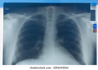 Chest X-ray Of A Healthy 40 Year Old Male, Viewed On Light Box. Top Down View.