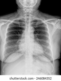  Chest X-ray. Healthy lungs