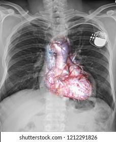 Chest X-ray A Human 57 Year Showing.Dual-chamber Pacemakersr In An Infant With Post-operative Complete AV Block After Surgery For Congenital Heart Disease.