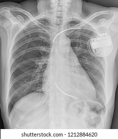 Chest X-ray A Human 65 Year Showing.Single-chamber Pacemakers In An Infant With Post-operative Complete AV Block After Surgery For Congenital Heart Disease.