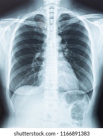 Chest Xray Human Physical Body Radiography Stock Photo 1166891383 ...