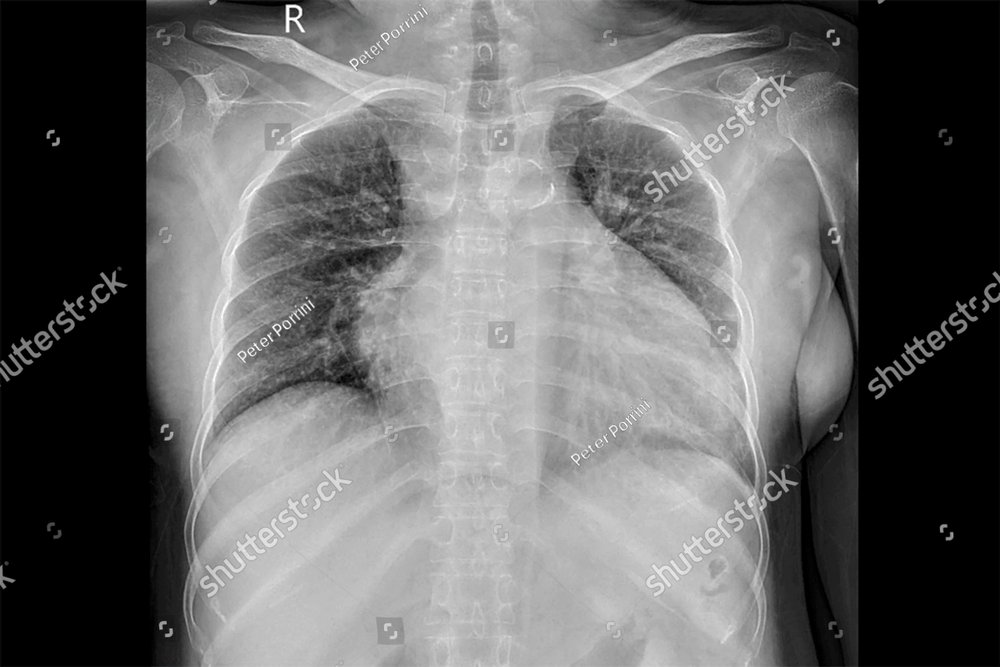 Chest x-ray image demonstrated heart, lungs, ribs, bones and muscles ...