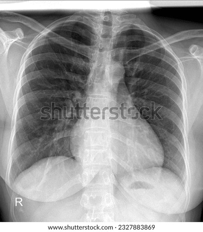 chest X-ray image demonstrating the trachea, bronchi, and lung parenchyma, useful for assessing lung diseases such as bronchitis, asthma, or chronic obstructive pulmonary disease (COPD).