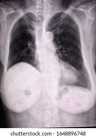 Chest X-ray image lungs evidence of post RUL lobectomy with compensatory hyperinflation of the remaining lobes and elevated right hemidiaphragm. Cardiomegaly with atherosclerotic change of aorta.