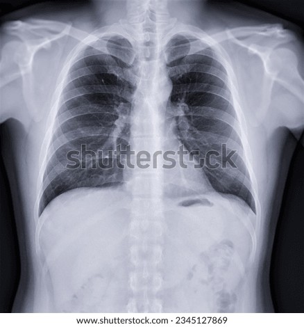 Chest x-ray image , Normal Chest.