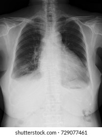 Chest X-ray Image (PA Upright Position), Case Of Chronic Heart Failure (CHF) Or Congestive Cardiac Failure (CCF)