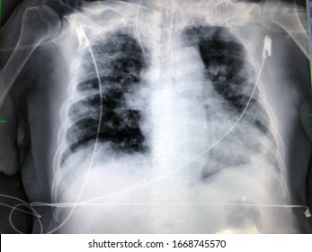 Chest X-ray Image Of Patient Tuberculosis Insertion With ECG. Systemic Inflammation Response Syndrome, Sepsis, Severe Sepsis And Septic Shock: Incidence, Morbidities In ICU Patients. Medical Education