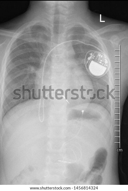 Chest Xray Image Permanent Pacemaker Implant Stock Photo (Edit Now ...