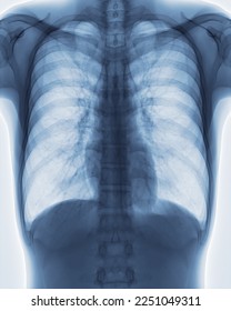 Chest x-ray image for screening diagnosis TB,tuberculosis and covid-19. - Shutterstock ID 2251049311