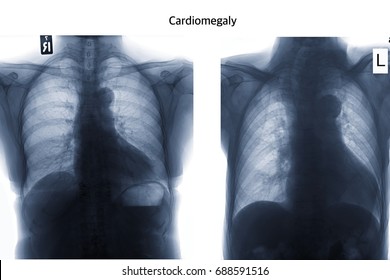 Chest Xray Image Show Cardiomegaly