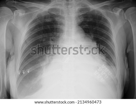 chest x-ray image of cardiomegaly 
chest x-ray image showing heart enlargement   , The cardio-thorax ratio should not be greater than 50% in people of normal size.
