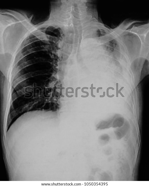 Chest X Ray Lung Infection - bronchitis contagious