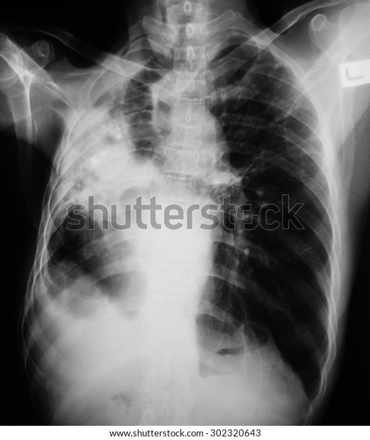 Chest Xray Image Showing Lung Infection Stock Photo 302320643 ...