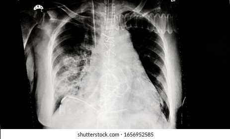 Chest X-ray Image Showing Right Venous Catheter, Chest Drain, Cardiomegaly With Post Valvular Replacement. Intact Eternal Wires. Reticular Opacity Left Basal Lung
