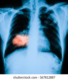 Chest Xray Image Shows Large Tumor Stock Photo (Edit Now) 367812887