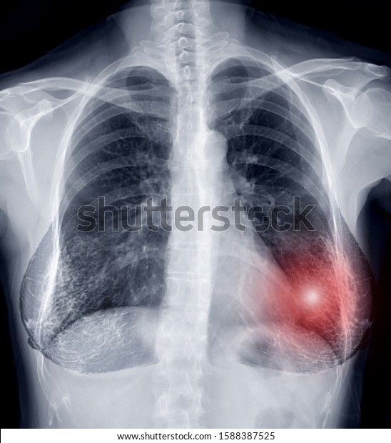 Chest Xray Xray Image Woman Chest Stock Photo (Edit Now) 1588387525