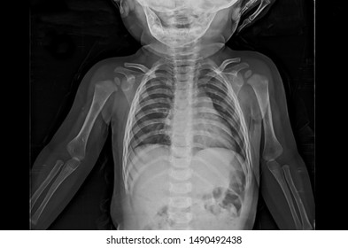 A chest x-ray of an infant patient showing normal heart, lung and chest wall. No sign of bronchitis, pneumonia, pleural effusion or heart attack.
