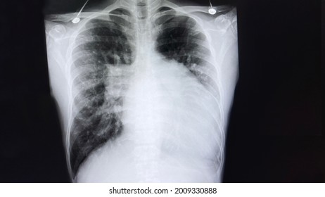 Chest X-ray Known Case Covid-19 Positive Shows Ground Glass Opacity At Peripheral Left Lung Infiltration. Left Hemidiaphragm  Is Partially Obscured At Heart Shadow.Cardiomegaly With Pulmonary Edema.