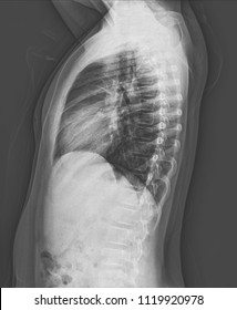 Chest X-ray Lateral A Boy 12 Year Old Normal Heart Size And Bony Thorax.