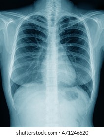 Chest X-ray , Xray Lung