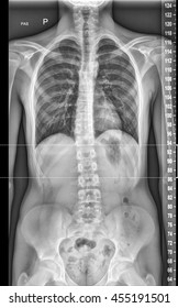 Chest Xray, Lungs And Heart View