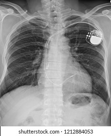 Chest X-ray A Man 57 Year Old  Showing Dual-chamber Pacemakersr In An Infant With Post-operative Complete AV Block After Surgery For Congenital Heart Disease. 