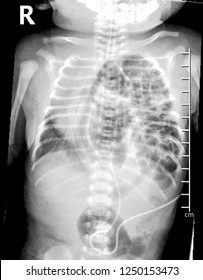 Chest X-ray of the newborn patient diagnosed as Congenital diaphragmatic hernia. (CDH is developmental defect of the diaphragm that allows abdominal viscera to herniate into the chest.)