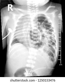 Chest X-ray of the newborn patient diagnosed as Congenital diaphragmatic hernia. (CDH is developmental defect of the diaphragm that allows abdominal viscera to herniate into the chest.)