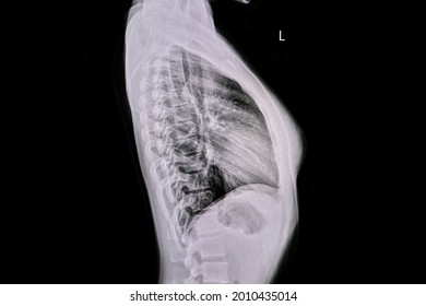 Chest Xray Normal Female Subject Lateral Stock Photo 2010435014 ...