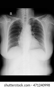 Chest Xray Old Woman Stock Photo (Edit Now) 471240998