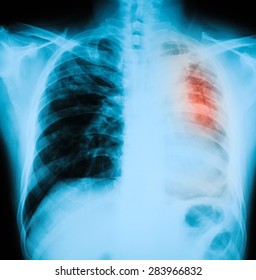 Chest Xray Pa Upright Position Shows Stock Photo 283966832 | Shutterstock