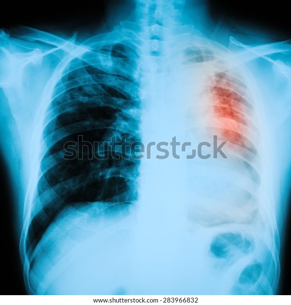 Chest Xray Pa Upright Position Shows Stock Photo 283966832 | Shutterstock