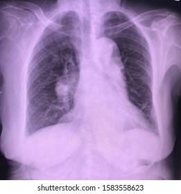 Chest X-ray PA Upright Shows Shows Normal Lung Volumes. Subsegmental Atelectasis At LLL Zone. No Pneumothorax Or Effusion. Cardiomegaly And Atherosclerotic Aorta. Enlarged Pulmonary Artery Trunks.