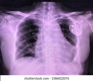 Chest X-ray Pa Upright Shows Dual Chamber Cardiac Pacemaker With Its Tips In RA And RV. Post Median Sternotomy With Intact Sternal Wires. Normal Lung Volumes. No Active Pulmonary Disease.