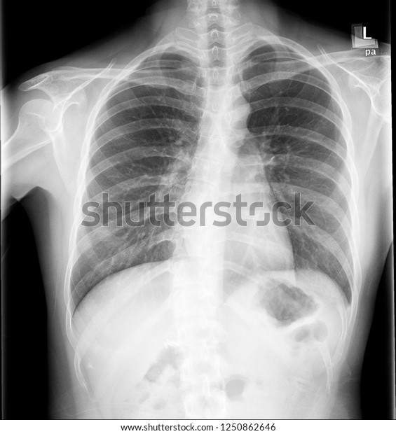 Chest Xray Pa View Stock Photo 1250862646 | Shutterstock