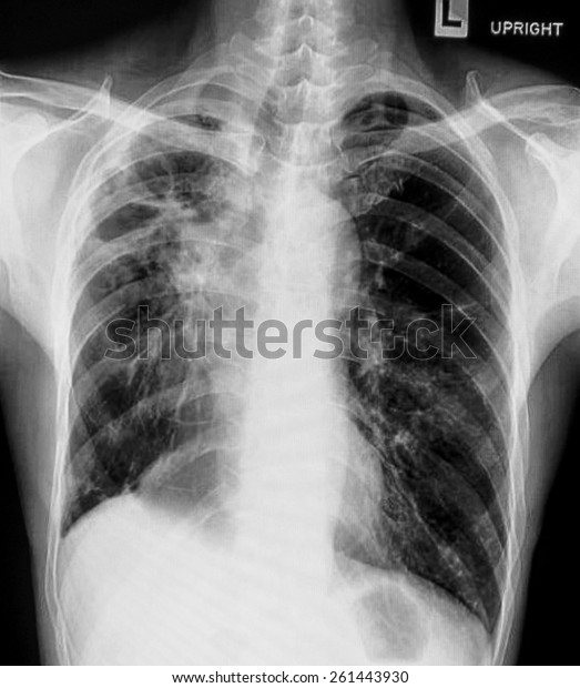 Chest Xray Pa View Stock Photo 261443930 | Shutterstock