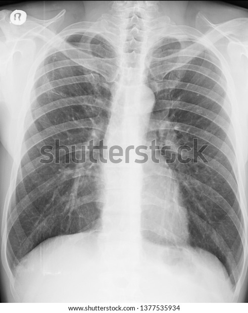 Chest Xray Pa View Lung Fields Stock Photo (Edit Now) 1377535934