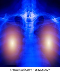 Chest X-ray Of  Patient Alveoli Damage Infected Coronavirus Or Covid-19 Concept.