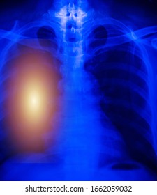 Chest X-ray Of  Patient Alveoli Damage Infected Coronavirus Or Covid-19 Concept.